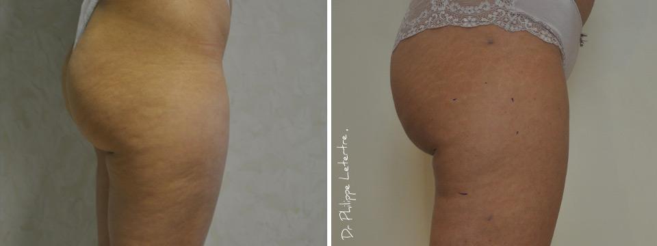 liposuccion des cuisses prix