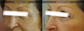 Blépharoplastie au laser avant-après