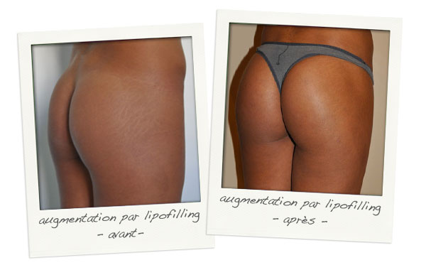 Augmentation des fesses par lipofilling