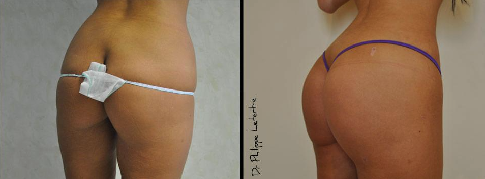 Augmentation des fesses par lipofilling