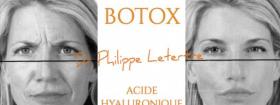 botox acide hyaluronique quelle différence