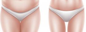 Chirurgie-du-ventre-plastie-abdominale-chirurgien-nice-cimiez