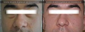 Parpados / Blefaroplastia 