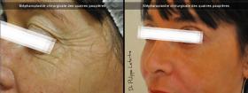 Parpados / Blefaroplastia 