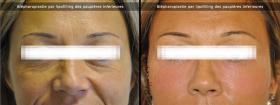 Blépharoplastie par lipofilling des paupières inférieures avant-après