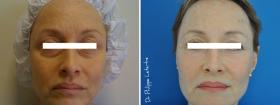 Blépharoplastie par lipofilling des paupières inférieures avant-après