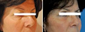 Parpados / Blefaroplastia 