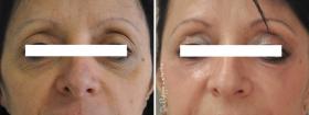 Blépharoplastie, lipofilling paupières supérieures et inférieures