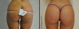 Fesses Lipofilling