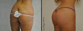 Augmentation des Fesses par lipofilling avant-après