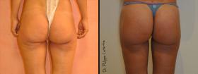 Aumento por lipofilling