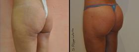 Augmentation des Fesses par lipofilling avant-après