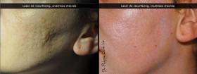 Laser de resurfacing, cicatrices d'acnés