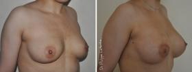 Augmentation par lipofilling avant-après