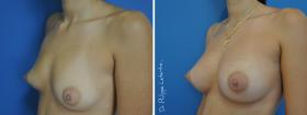 Augmentation par lipofilling avant-après