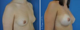 Augmentation par lipofilling avant-après