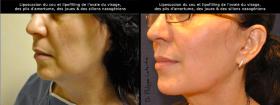 Liposuccion du cou et lipofilling du visage