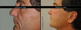 Lipofilling du visage 