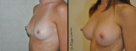 Augmentation mammaire avant-après