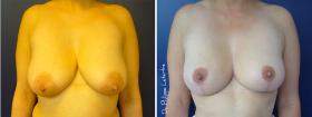 Réduction mammaire avant-après