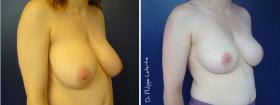 Reducción mamaria antes-despues