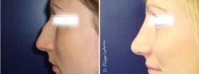 Rinoplastia antes-despues