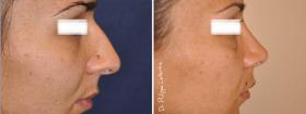 Rinoplastia antes-despues