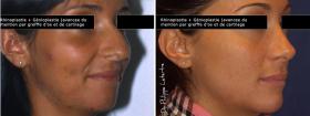 Rhinoplastie + Génioplastie avant-après