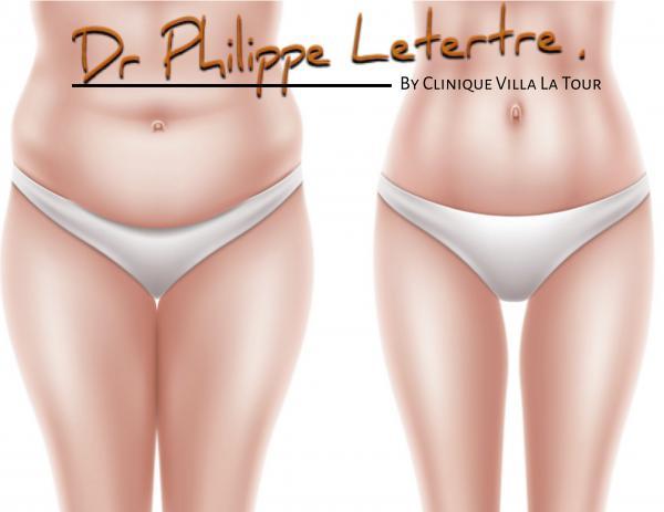 Chirurgie-du-ventre-plastie-abdominale-chirurgien-nice-cimiez