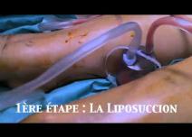 lipofilling mollets Dr Philippe LETERTRE Nice Cannes Monaco Côte d'azur