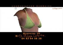 Augmentation Mammaire : Morphing 3D by Dr Philippe LETERTRE